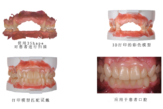 3Shape彩色工作流程，讓牙齒假體越來(lái)越“真”！